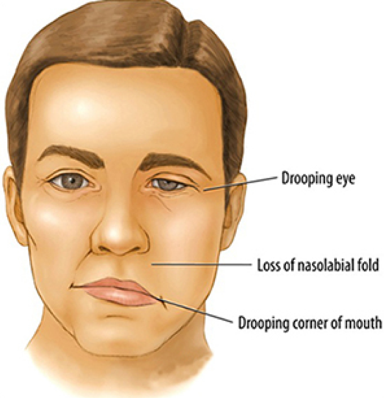 Онемевает правая сторона лица. Микроинсульт симптомы у мужчин последствия. Симптомы ммкро инсултта. Микроинсульт лица симптомы.