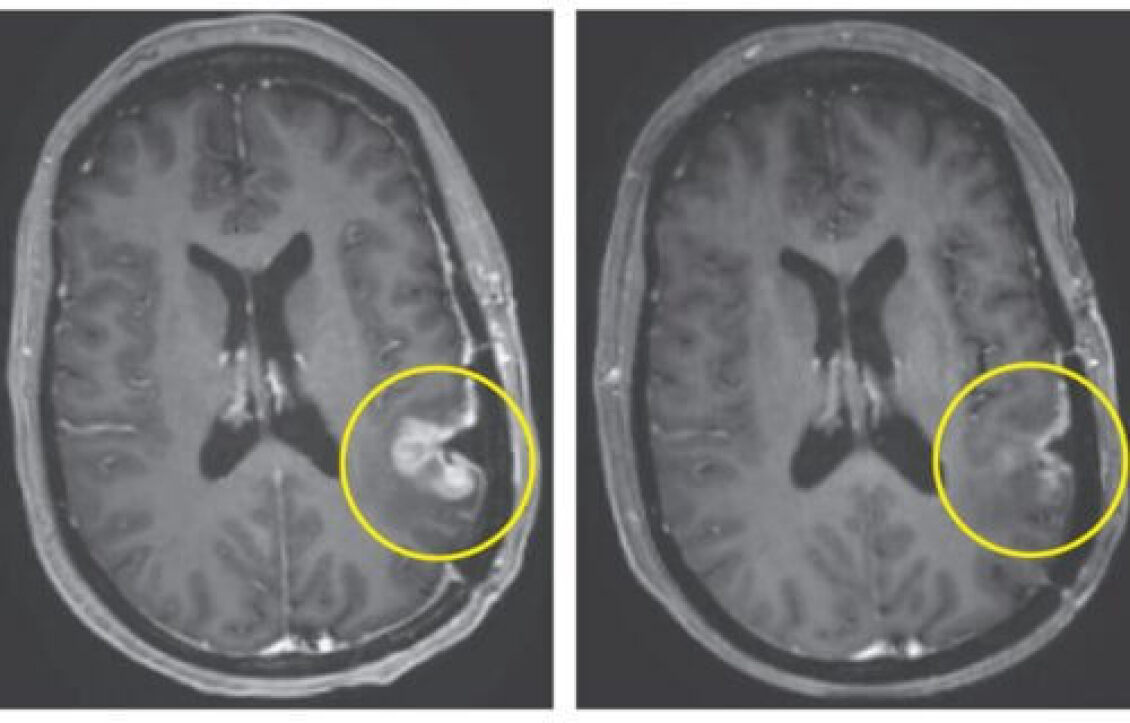 brain-cancer-tumor-500x320-1