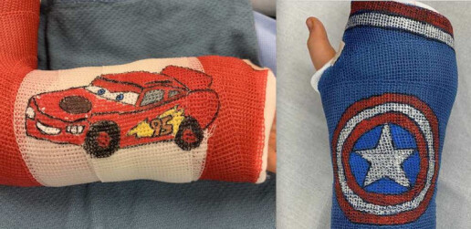 art-on-arm-casts-shriners-childrens